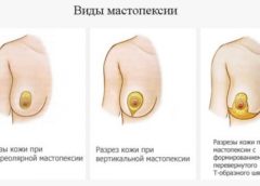 Чем поможет мастопексия?