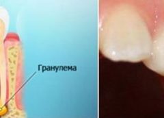 Гранулема зуба: что это и как лечить?