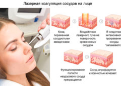 Удаление купероза и сосудов на носу — основные аспекты